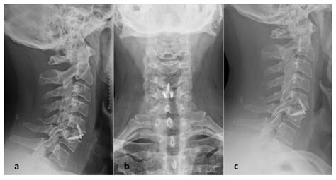 JPM Free Full Text Single Level Anterior Cervical Discectomy And