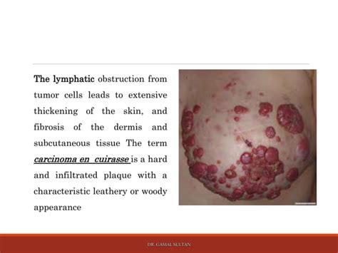 Cutaneous Manifestations Of Internal Malignancy And Paraneoplastic