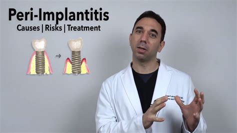 Peri Implantitis Infected Dental Implant Treatment Options Youtube