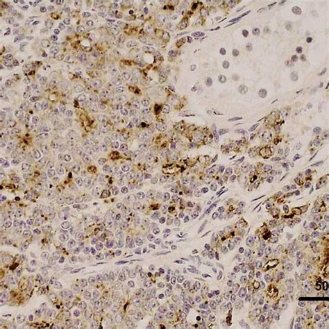 Prostate Specific Antigen Immunostaining Is Positive Download