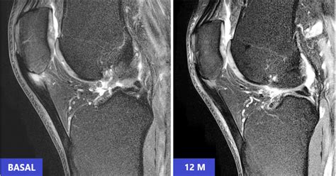 Patellar Tendon Regeneration With Cell Therapy Itrt