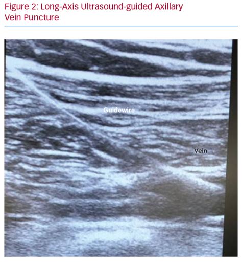 Long Axis Ultrasound Guided Axillary Vein Puncture Radcliffe Cardiology