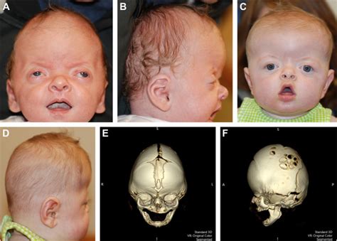 Syndromic Craniofacial Disorders Facial Plastic Surgery Clinics