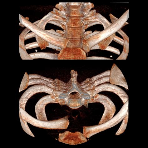 DislocationSternoclavicularJoint02MDRightCheckedInHockeyCT3DAPAndAbove1