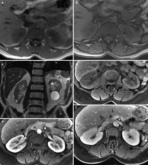 Renal Parenchymal Tumor Imaging Radiology Key