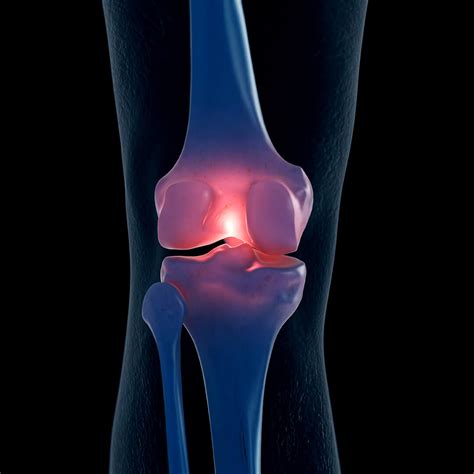 Osteoarthritis Treatment | Northeast Knee & Joint Institute