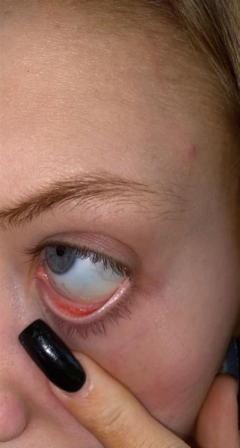 Norm Eyelid Colour Or Suggestion Of Low Iron Again Ranemia