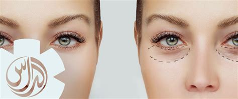 Medical Eye Bag Treatment, Dubai | Al Das Medical Clinic