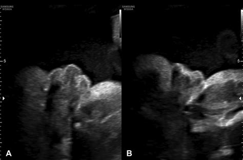 Ambiguous Genitalia Ultrasound