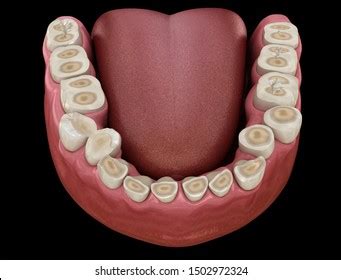 Attrition Teeth Images, Stock Photos & Vectors | Shutterstock