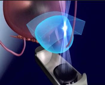 Successful Non-Invasive procedure for Prostate Cancer – PMC Regional ...