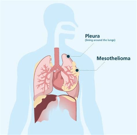 Mesothelioma Stages The Lanier Law Firm