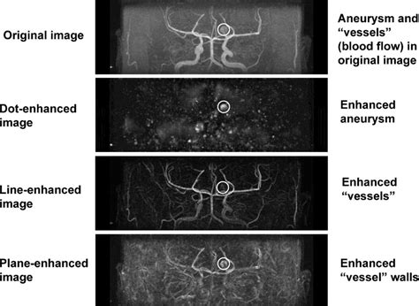 Illustration Of An Original Magnetic Resonance Angiography Mra Image Download Scientific