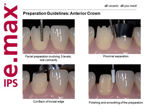 All Ceramic Crown Preparation