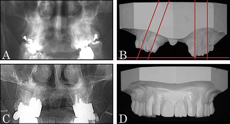 Interdisciplinary Treatment Of An Adult With Complete Bilateral Cleft Lip And Palate American