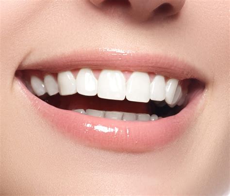 Porcelain Veneers Archives Alex Bell Dental