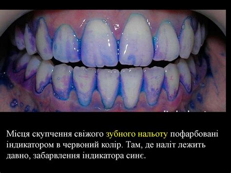 укр ЕМАЛЬ ДЕНТИН ЦЕМЕНТ - презентация онлайн