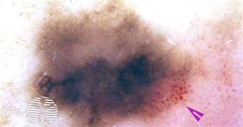 Bowens Disease Image
