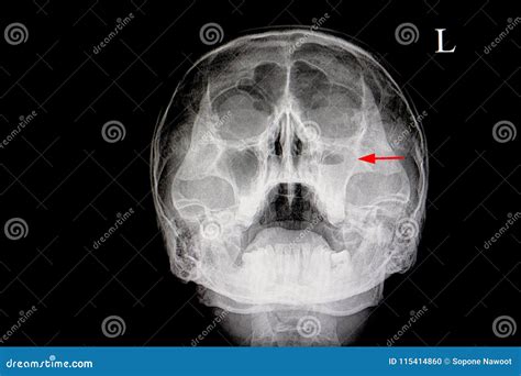 Acute maxillary sinusitis stock photo. Image of human - 115414860