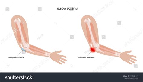 100 Elbow Bursa Anatomy Images Stock Photos Vectors Shutterstock