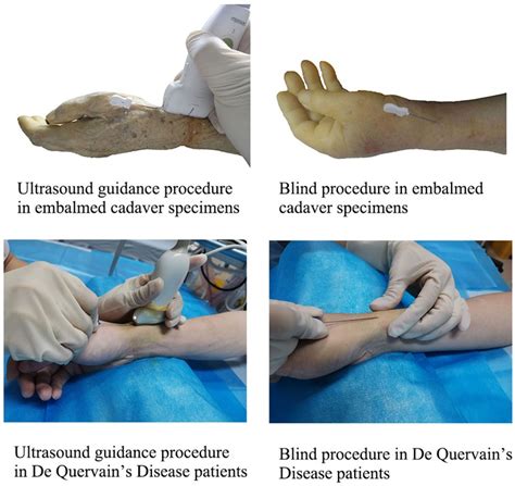 Frontiers The Ultrasound Guided Percutaneous Release Technique For De