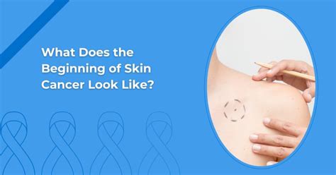 What Does The Beginning Of Skin Cancer Look Like Associated