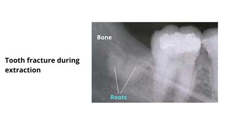 Tooth Extraction Complications A Comprehensive Guide With Pictures