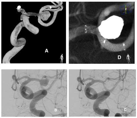 Jcm Free Full Text Evaluation Of The Accero Stent For Stent