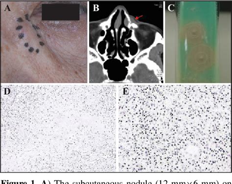 Figure From A Case Of Cutaneous Tuberculosis A Clue To Diagnosing