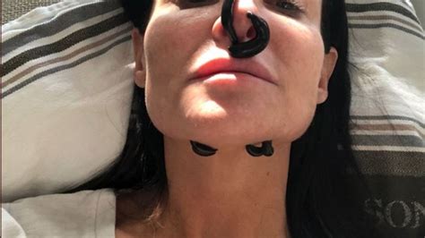 Boynton Beach Beauty Blogger Uses Leeches To Save Nose After Botched
