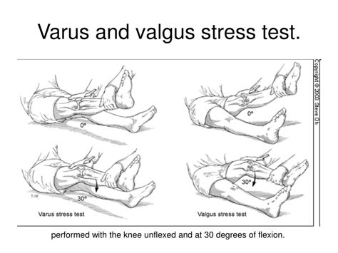 Valgus Stress Test Medial Collateral Ligament Mcl Injury 52 Off