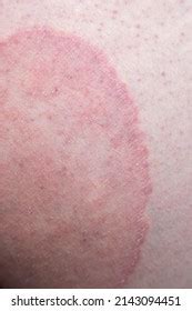 Tinea Cruris Known Jock Itch Common库存照片2143094451 Shutterstock