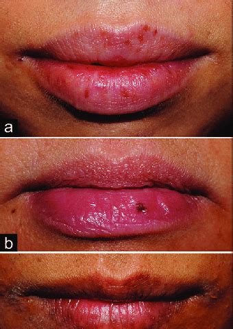 Labial melanotic macules in atopic dermatitis. (a) Multiple macular ...