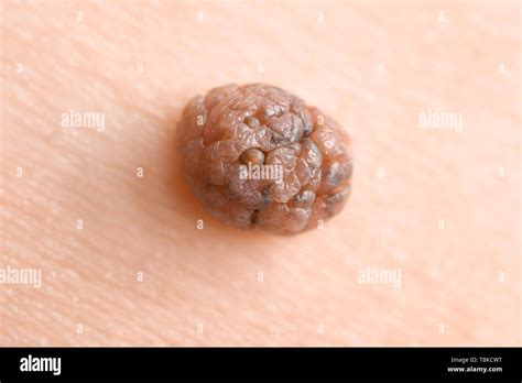 Human Skin With Mole Closeup Stock Photo Alamy