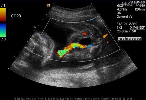 Umbilical Artery Ultrasound