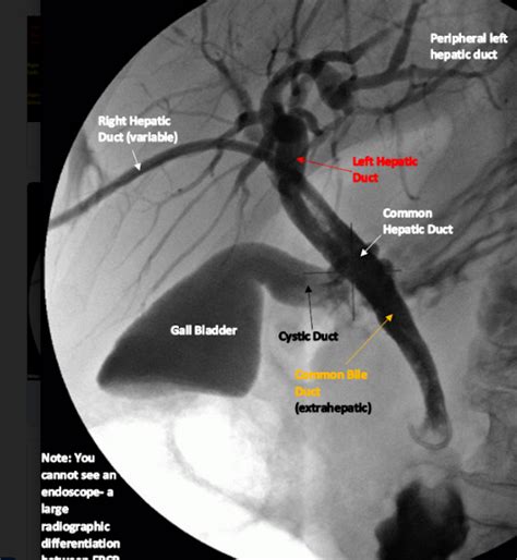 Ptc Percutaneous Transhepatic Cholangiogram Diagram Quizlet