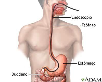 Qu Es La Endoscopia Superior Cega