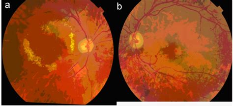 Flame Shaped Hemorrhages