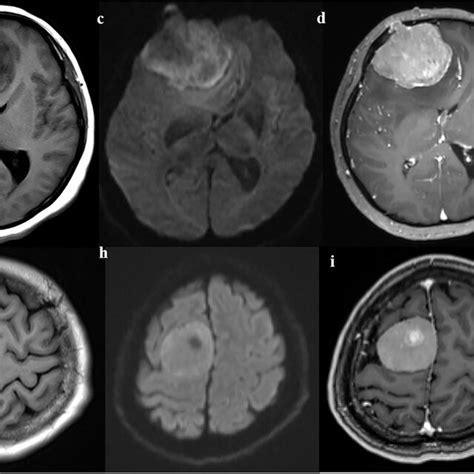 Examples Of Different Mri Features Of Meningiomas In The Invasion And