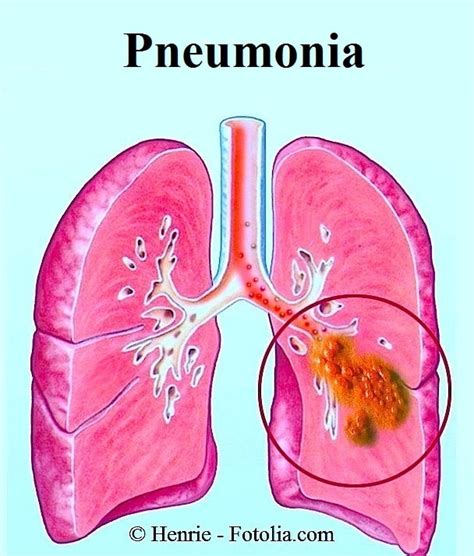 Sintomas de pneumonia viral e tratamento | Fisioterapia para todos