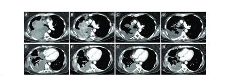 Tumor Regression On Sequential Contrast Enhanced Ct Scans Cect Of The