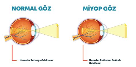 Auckland bağlantı Güzelleşmek göz hastalıkları miyop Terbiyesizce