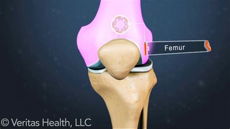 Symptoms of Kneecap Dislocation | Diet plans for men, Dislocation, Knee ...