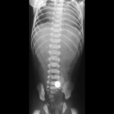 Esophageal Atresia Without Tracheo Esophageal Fistula Pediatric