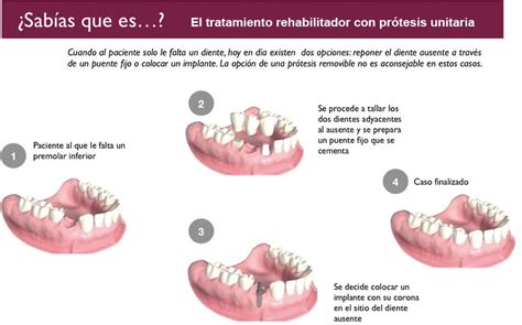 Prostodoncia CLINICA DENTAL DOLORES ALVAREZ