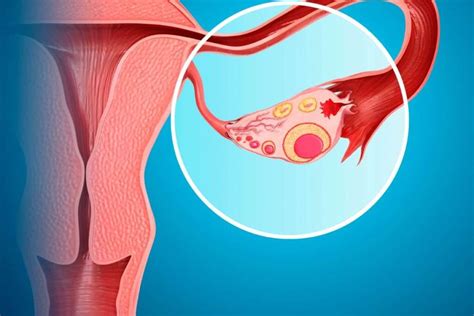 Ovarian Cysts During Pregnancy Gold Rush Hospital