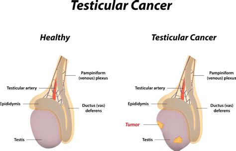 Testicular Cyst Vs Cancer