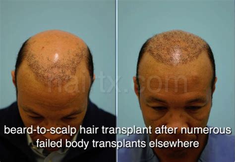 Body Hair Transplant Procedure Dallas Tx Dr Sam Lam