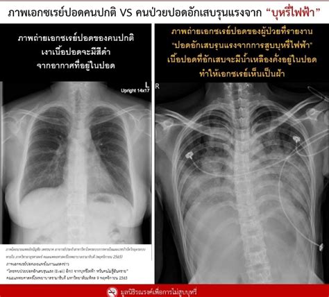 누디⁷ The Astronaut on Twitter RT TSererak ตอนนไทยพบผปวยปอด