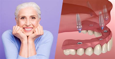 Full Mouth Dental Implants Houston Texas